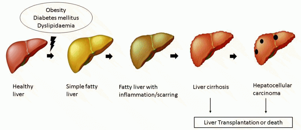 Metabolic dysfunction-Associated Steatotic Liver Diseases
