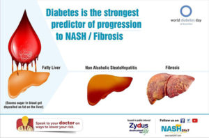 Diabetes is the strongest predictor of progression of MASH