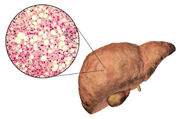 Metabolic dysfunction-Associated Steatotic Liver Disease
