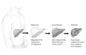 fat in liver causes