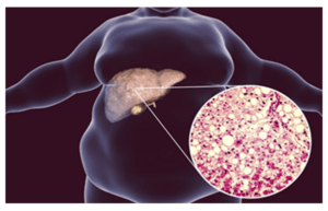 Fat liver