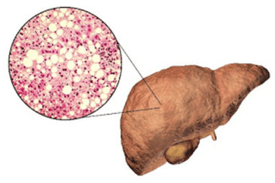 Metabolic dysfunction-Associated Steatotic Liver Disease