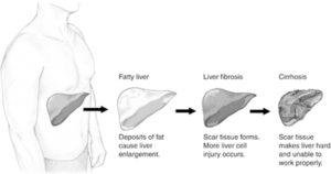 liver cancer and nafld