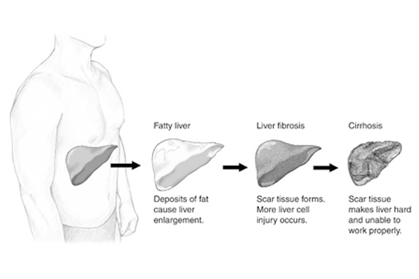 liver cancer and nafld