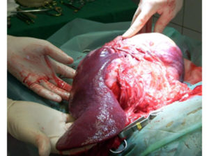 liver cancer treatment