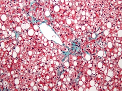 Prevalence: MASLD in India 2020