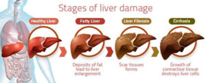 know about Metabolic dysfunction-Associated Steatotic Liver Disease