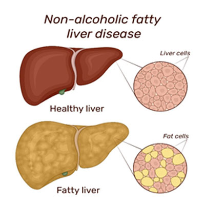 Metabolic dysfunction-Associated Steatohepatitis