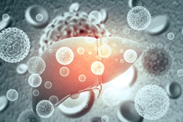 Metabolic dysfunction-Associated Steatotic Liver Disease