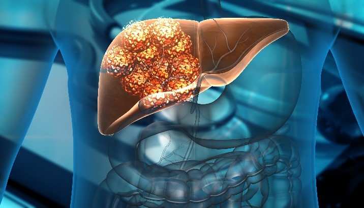 Is Metabolic dysfunction-Associated Steatohepatitis (MASH ) Life Threatening? Is Metabolic dysfunction-Associated Steatohepatitis (MASH ) Life Threatening?