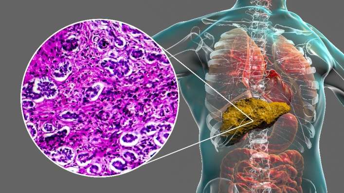 cirrhosis symptoms