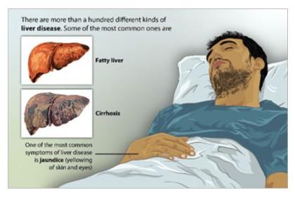 cirrhosis symptoms